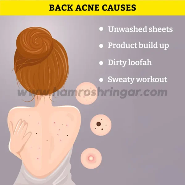 Chemist at Play Acne Control Body Wash (3% Pentavitin + 1% Salicylic Acid) - Back Acne Causes