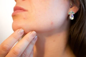 Featured image for “Acne-Prone Skin”