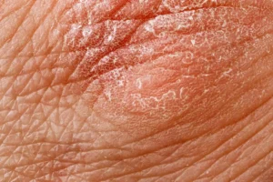 Featured image for “Dry Skin”